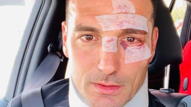 El DT de la Selección fue atropellado en Mallorca y está internado