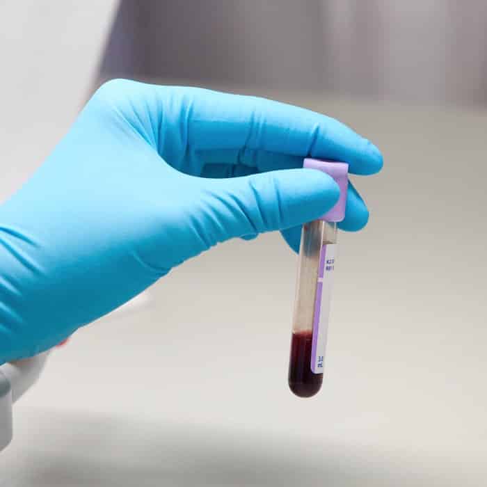 Recomiendan a personas con hemofilia extremar los cuidados por la pandemia