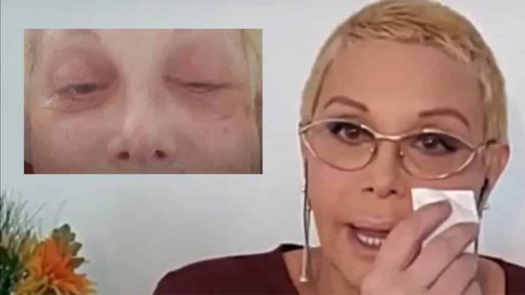 Carmen Barbieri contó su traumática afección con el herpes zóster: Todavía no tengo la cara de antes