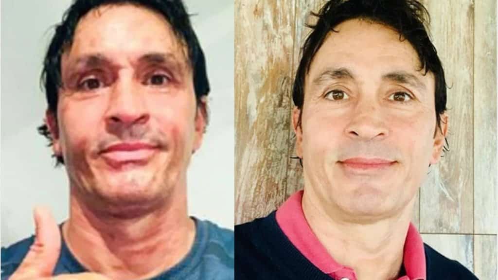 Sebastián Estevanez mostró la increíble mejora en su piel tras quemarse la cara al estallarle un bidón de alcohol