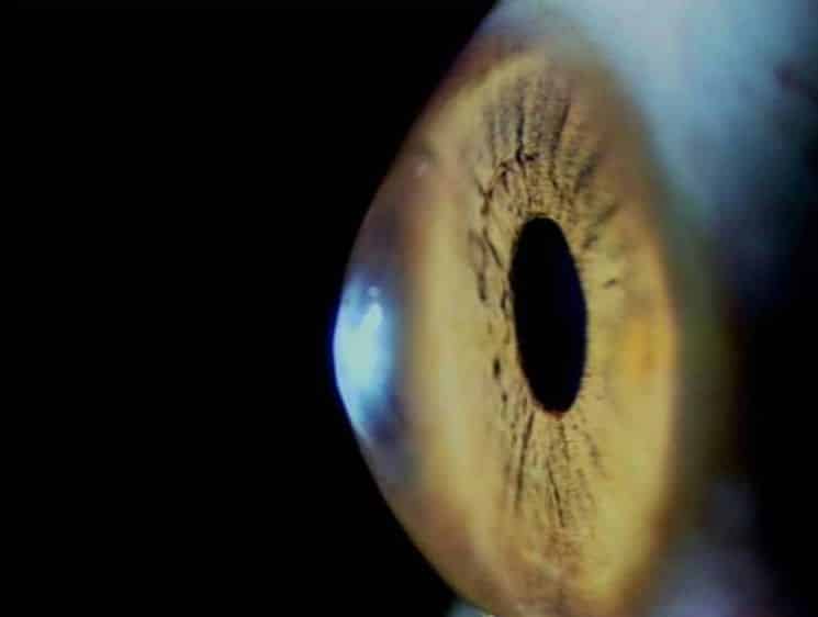 Identifican un nuevo síntoma del Post COVID: alteraciones en la superficie de los ojos