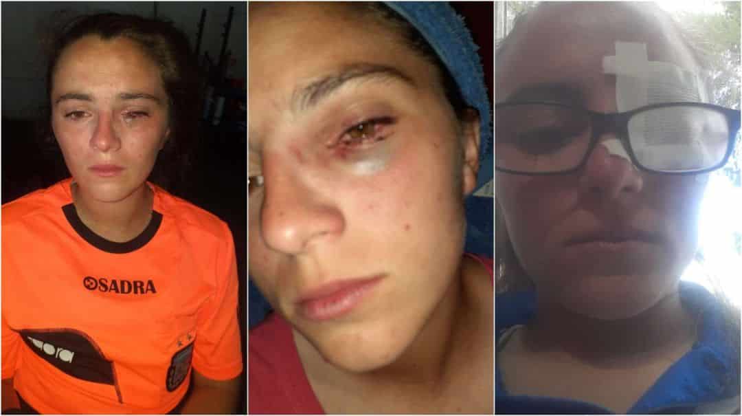 Operaron del ojo a una árbitra tras recibir varias patadas en la cara en un partido de fútbol femenino