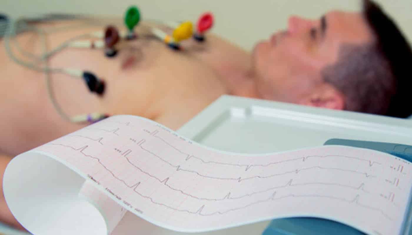 Arritmia como secuela del coronavirus: qué estudios hay que hacer antes de iniciar un deporte