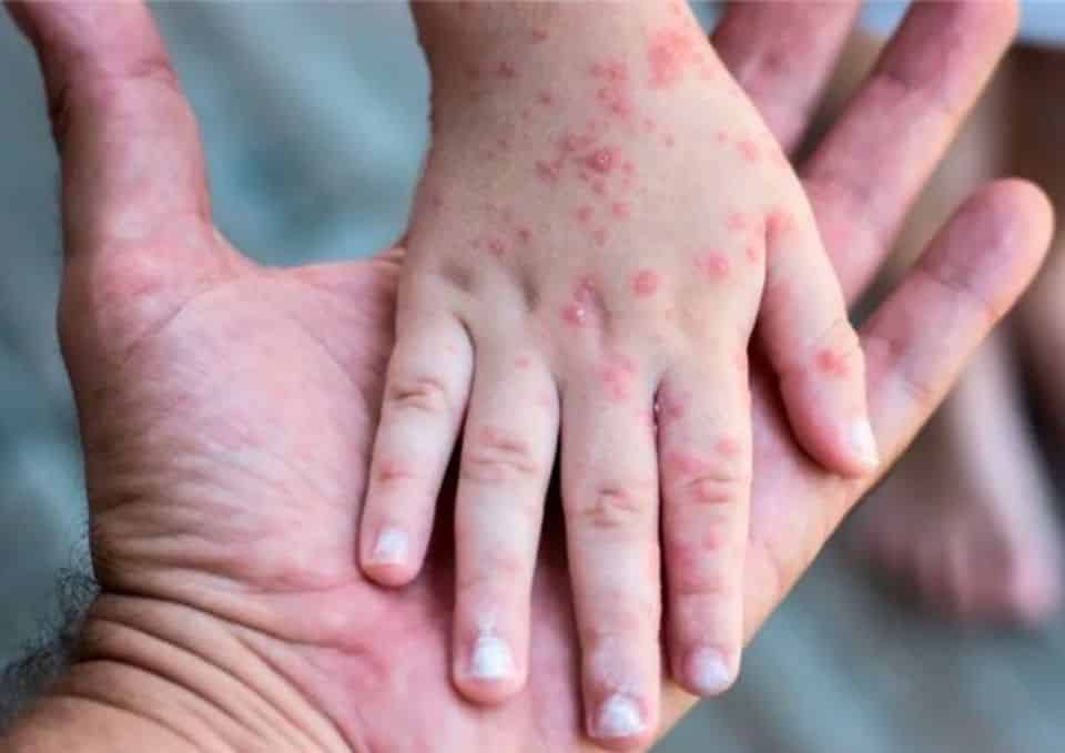 Qué es la enfermedad de mano-pie-boca, tan viral y contagiosa en los más chicos