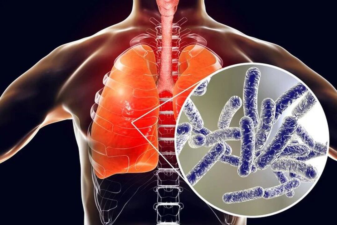Legionella en la Argentina: todo lo que hay que saber de la bacteria que causó el brote en Tucumán