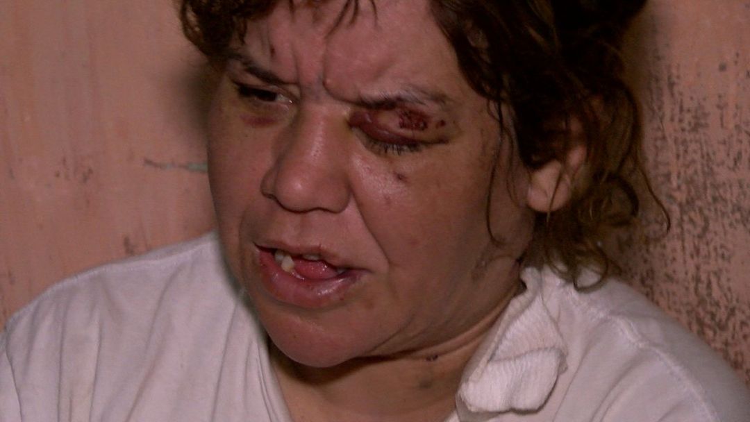 Habló la mujer que fue agredida con un hacha en su cabeza: “Me fui del hospital porque mi pareja está mal, cuando lo liberen me voy a internar, me tienen que operar”