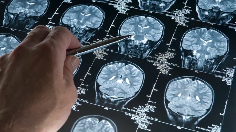 Alzheimer: un fármaco en investigación mostró resultados alentadores ante el deterioro cognitivo
