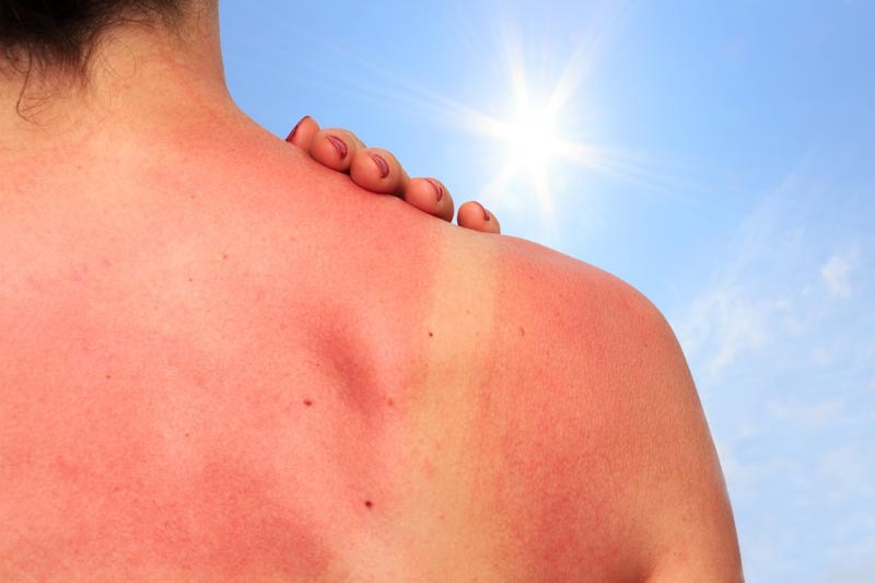 Cómo cuidar la piel de las quemaduras del sol