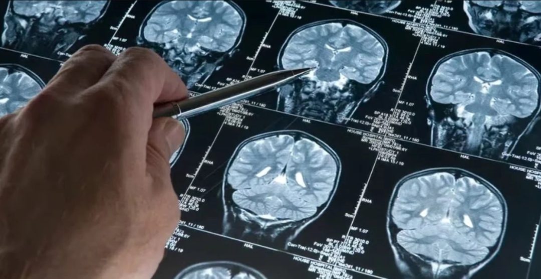 Científicos de la UBA investigan cómo detectar el alzheimer con inteligencia artificial