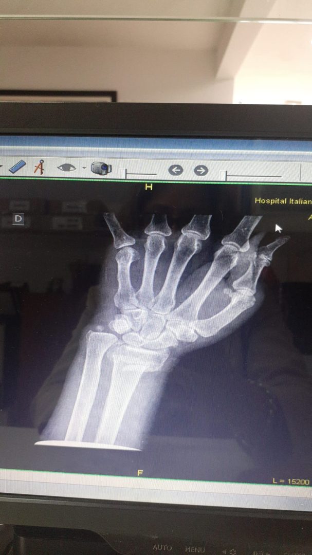 Está fracturada y PAMI no consigue una placa para su operación: “El dolor es insoportable”