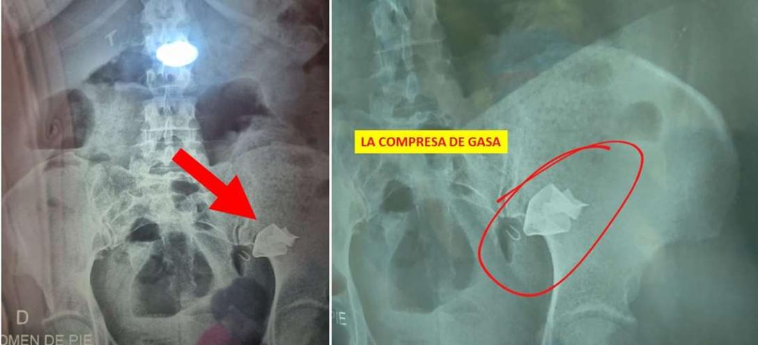 Condenan a una instrumentadora y a una enfermera por haber olvidado una gasa dentro de una paciente