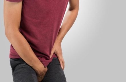 varicocele