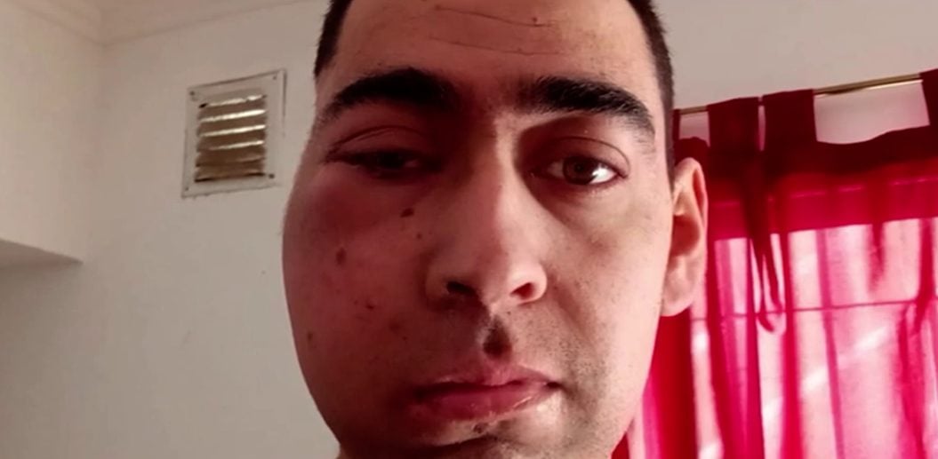 Un joven bahiense con cáncer maxilofacial: “Mi hijo no puede trabajar y necesita ayuda para seguir el tratamiento”