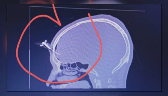 Qué se sabe del estado de salud del hombre que fue apuñalado en el cráneo con una llave de auto