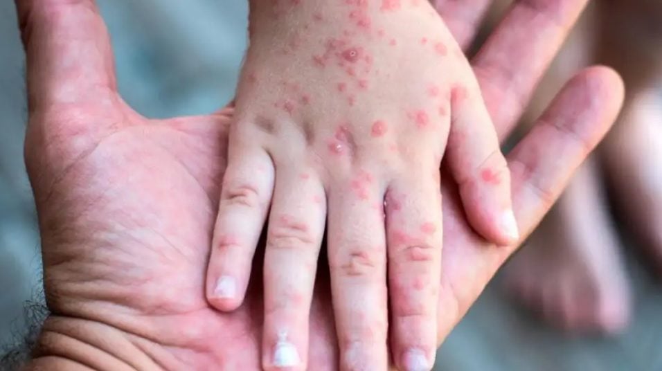 Alerta por sarampión y el avance del discurso antivacunas: Fuerte advertencia de la PBA