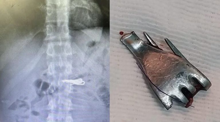 Santa Fe: un preso de alto perfil se tragó un tenedor en la cárcel y terminó internado bajo estricta custodia